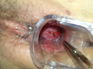 Mirena Spirale ziehen inference IUD IUP entfernen